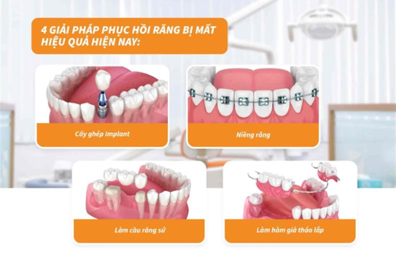 Các Giải Pháp Phục Hồi Răng Bị Mất Hiệu Quả Nhất Hiện Nay