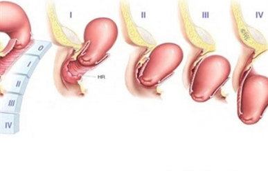 Sa tử cung có quan hệ được không?