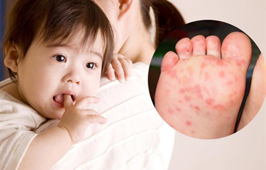 4 Giai Đoạn Phát Triển Bệnh Tay, Chân, Miệng: Đặc biệt cần lưu ý !