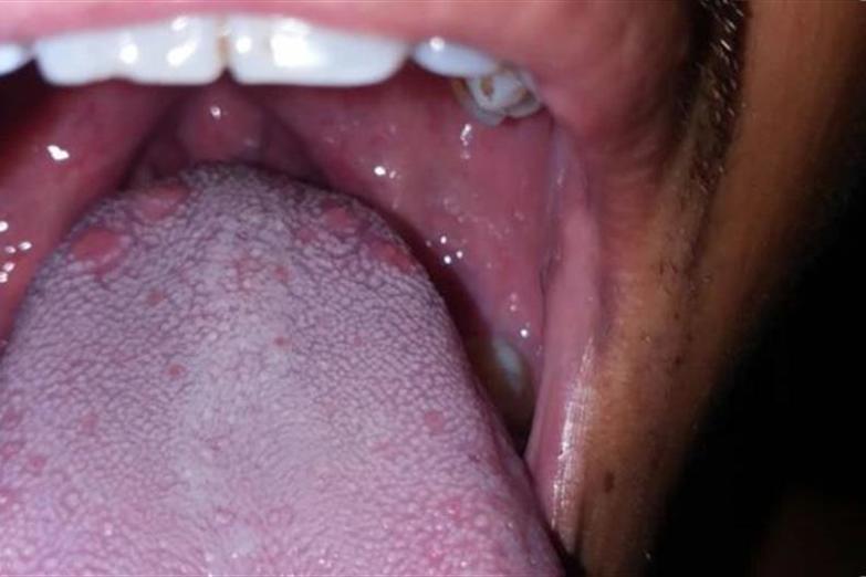 Có những biện pháp phòng ngừa cuống lưỡi nổi mụn đỏ không?
