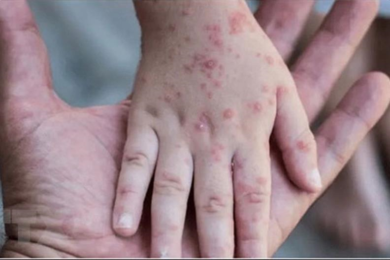 Bệnh đậu mùa khỉ là gì? Nguyên nhân gây ra đậu mùa khỉ?