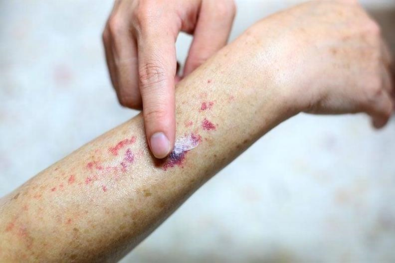 Tại Sao Bị Ung Thư Máu Và Dấu Hiệu Bị Ung Thư Máu? 