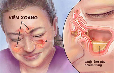 Các Loại Viêm Xoang Phổ Biến Và Cách Điều Trị Từng Loại