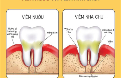 Cách Phân Biệt Giữa Viêm Nha Chu và Viêm Nướu