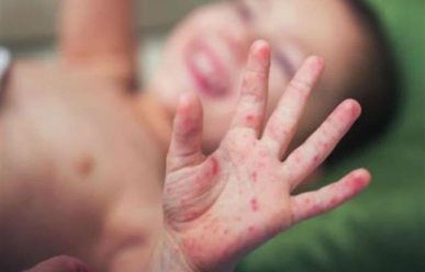 Trẻ bị sởi làm gì cho nhanh khỏi?