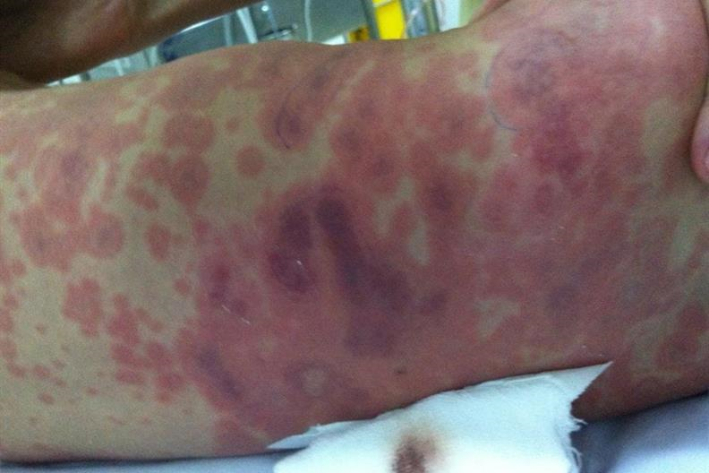 Bệnh Viêm Màng Não Do Não Mô Cầu: Nguyên Nhân, Triệu Chứng Và Cách Phòng Chống