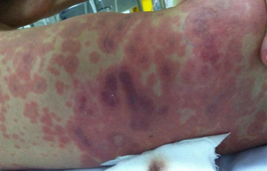 Bệnh Viêm Màng Não Do Não Mô Cầu: Nguyên Nhân, Triệu Chứng Và Cách Phòng Chống