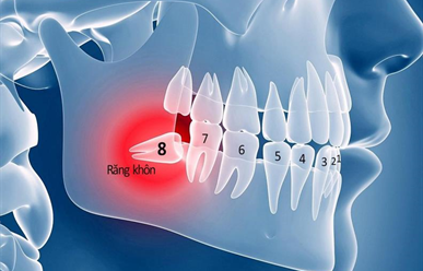 Nhổ răng khôn có đau không?