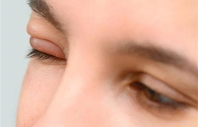 Bị lẹo mắt, làm sao để mau khỏi?