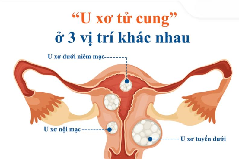 3 vị trí u xơ tử cung thường gặp, ảnh hưởng đến sức khỏe nữ giới