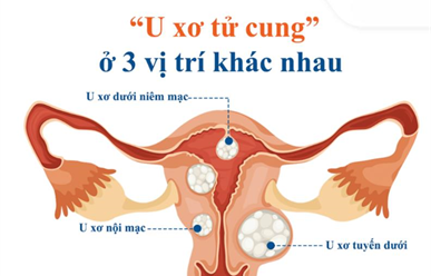 3 vị trí u xơ tử cung thường gặp, ảnh hưởng đến sức khỏe nữ giới