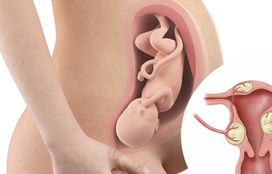 U xơ tử cung ảnh hưởng như thế nào đến thai kỳ?