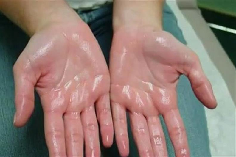 Chảy mồ hôi ở tay và chân là bệnh gì?